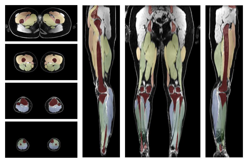 Overlay of automated muscle segmentation labels on dixon water image.