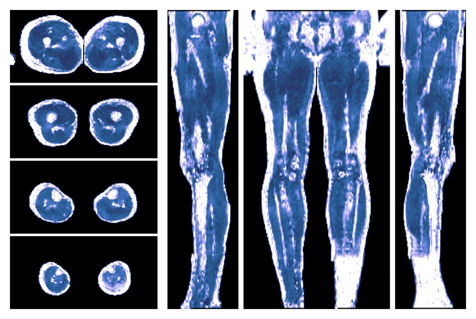 IVIM corrected whole leg muscle fractional anisotropy obtained from diffusion tensor imaging.