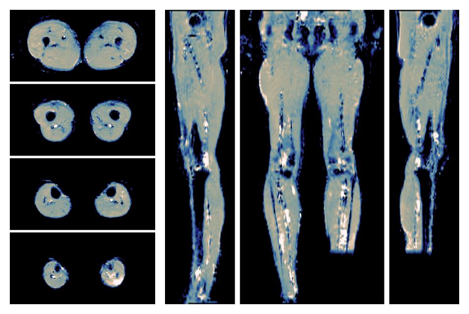 IVIM corrected whole leg muscle mean diffusivity obtained from diffusion tensor imaging.