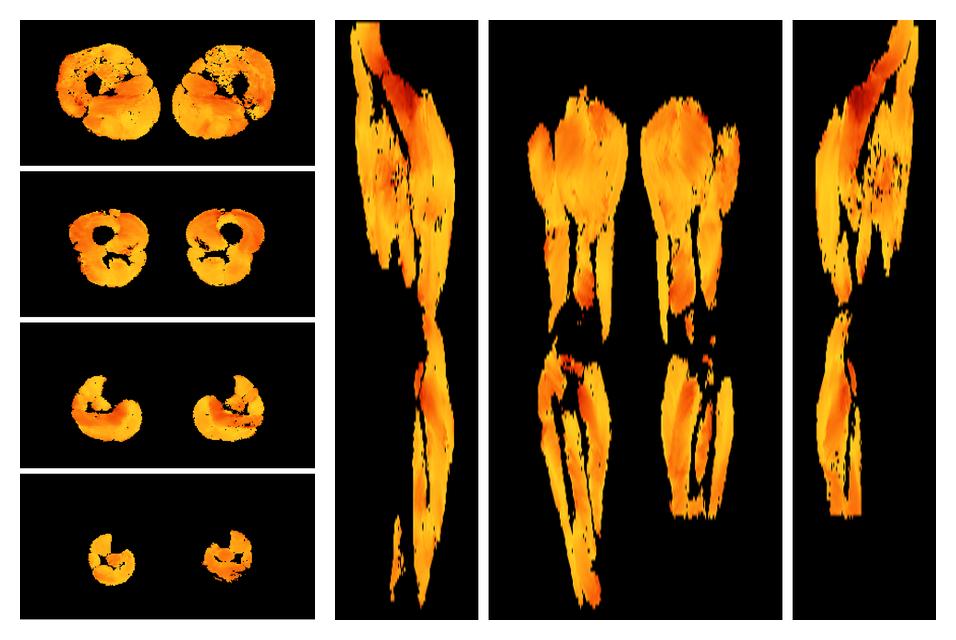 Muscle fiber tract angle map based on whole leg DTI based fiber tractography.