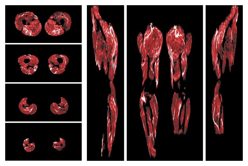 Muscle fiber tract density map based on whole leg DTI based fiber tractography.