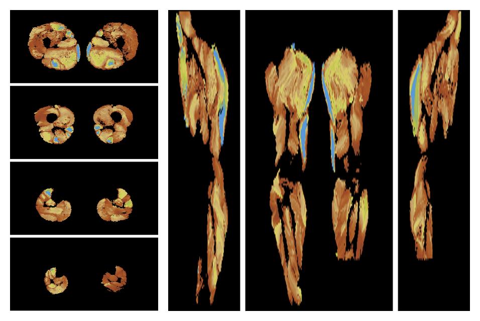 Muscle fiber tract length map based on whole leg DTI based fiber tractography.