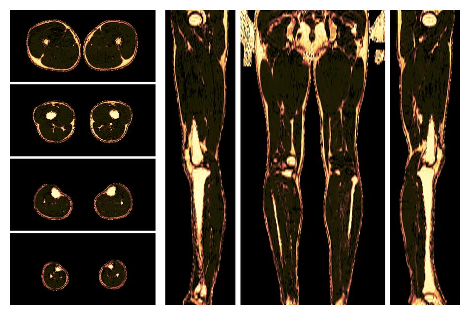 The fat fraction of the lower extremity obtained from the dixon reconstruction for muscle water fat quantification.