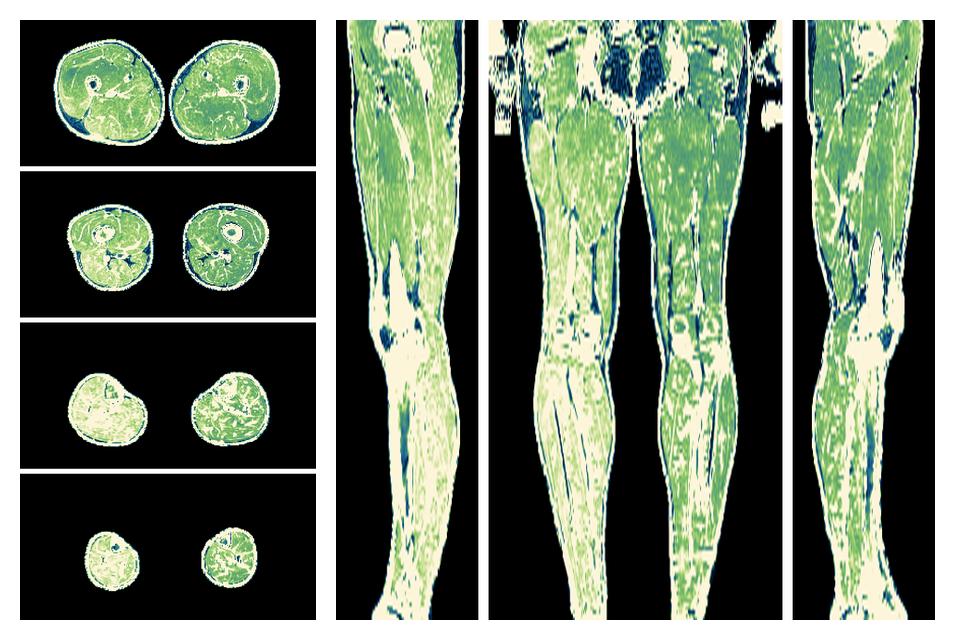 The R2 star relaxation time of the lower extremity obtained from the dixon reconstruction for muscle water fat quantification.