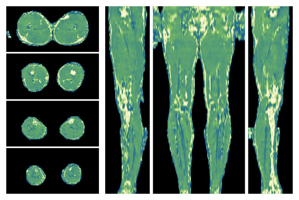 The water only T2 relaxation time of the lower extremity obtained from multi echo spin echo t2 mapping with EPG based reconstruction.