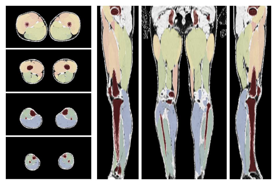 Overlay of automated muscle segmentation labels on dixon water image.