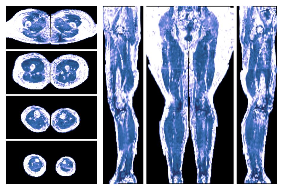 IVIM corrected whole leg muscle fractional anisotropy obtained from diffusion tensor imaging.