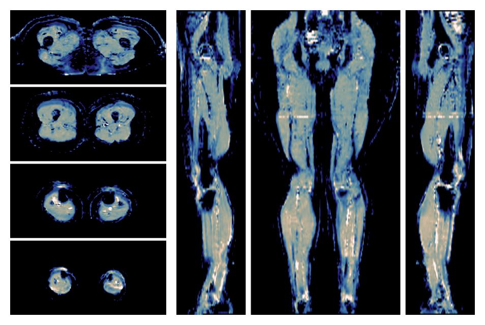 IVIM corrected whole leg muscle mean diffusivity obtained from diffusion tensor imaging.