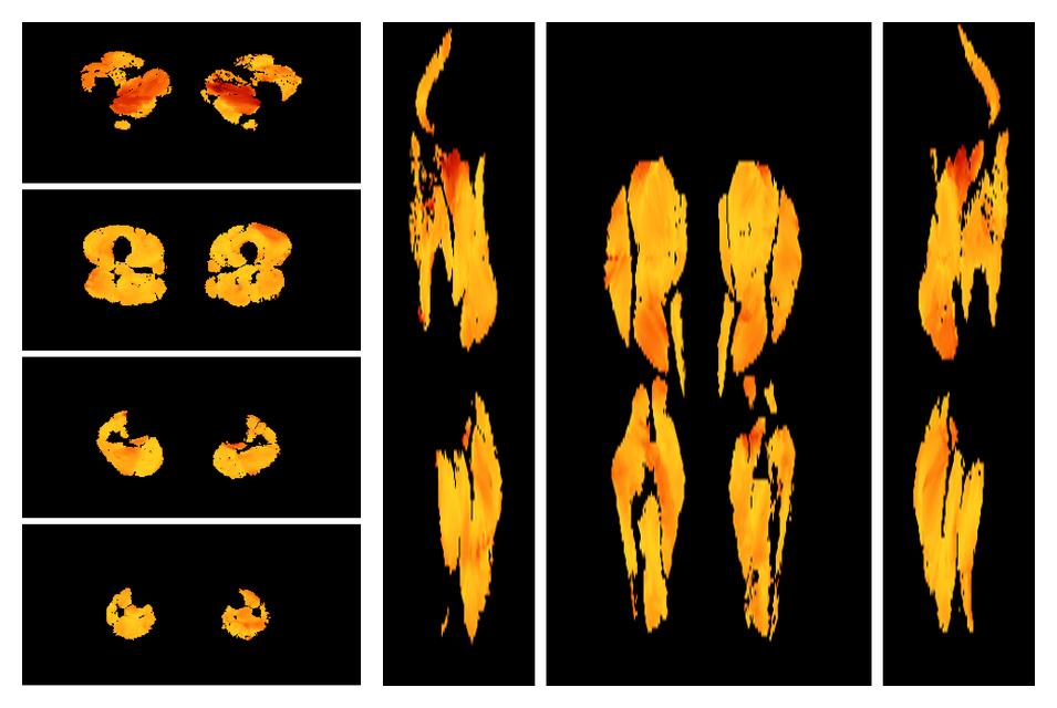 Muscle fiber tract angle map based on whole leg DTI based fiber tractography.