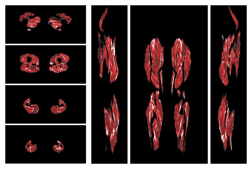 Muscle fiber tract density map based on whole leg DTI based fiber tractography.