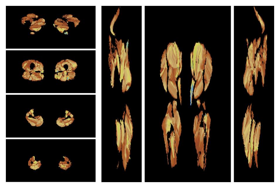 Muscle fiber tract length map based on whole leg DTI based fiber tractography.