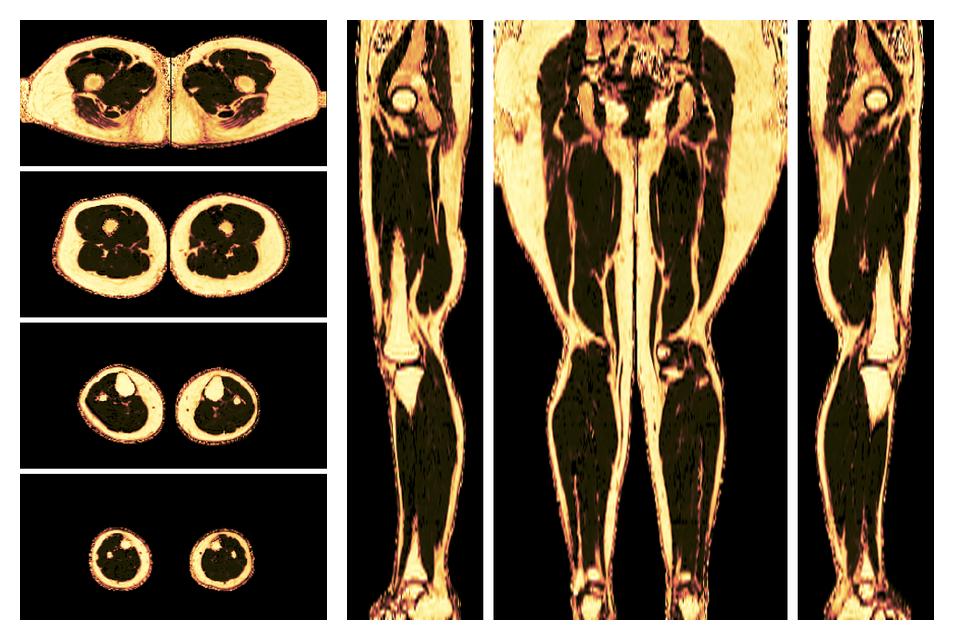 The fat fraction of the lower extremity obtained from the dixon reconstruction for muscle water fat quantification.