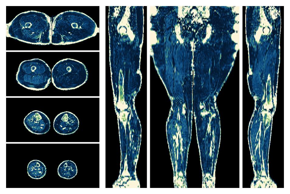 The R2 star relaxation time of the lower extremity obtained from the dixon reconstruction for muscle water fat quantification.