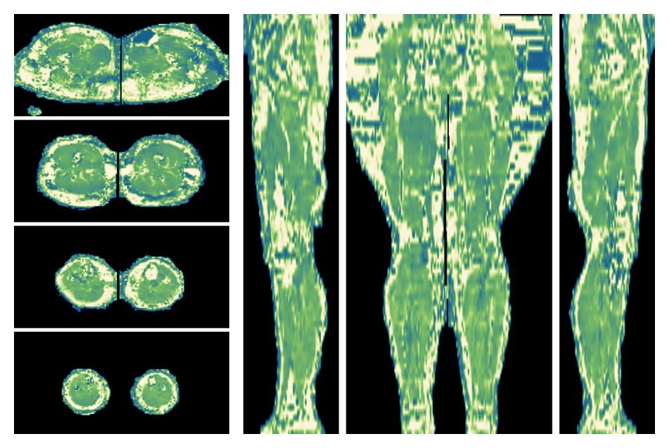 The water only T2 relaxation time of the lower extremity obtained from multi echo spin echo t2 mapping with EPG based reconstruction.