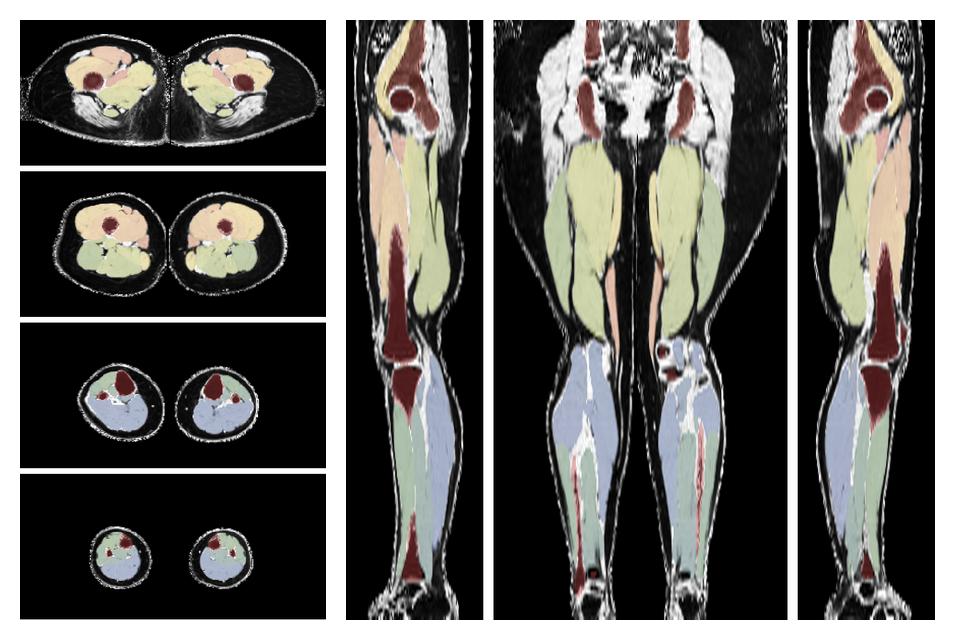 Overlay of automated muscle segmentation labels on dixon water image.