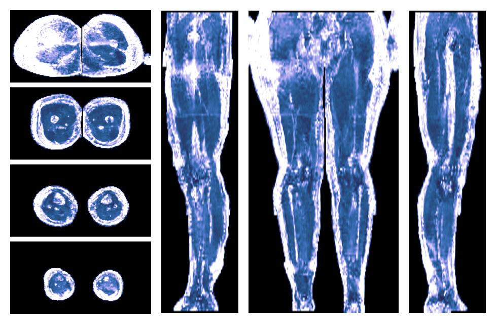 IVIM corrected whole leg muscle fractional anisotropy obtained from diffusion tensor imaging.