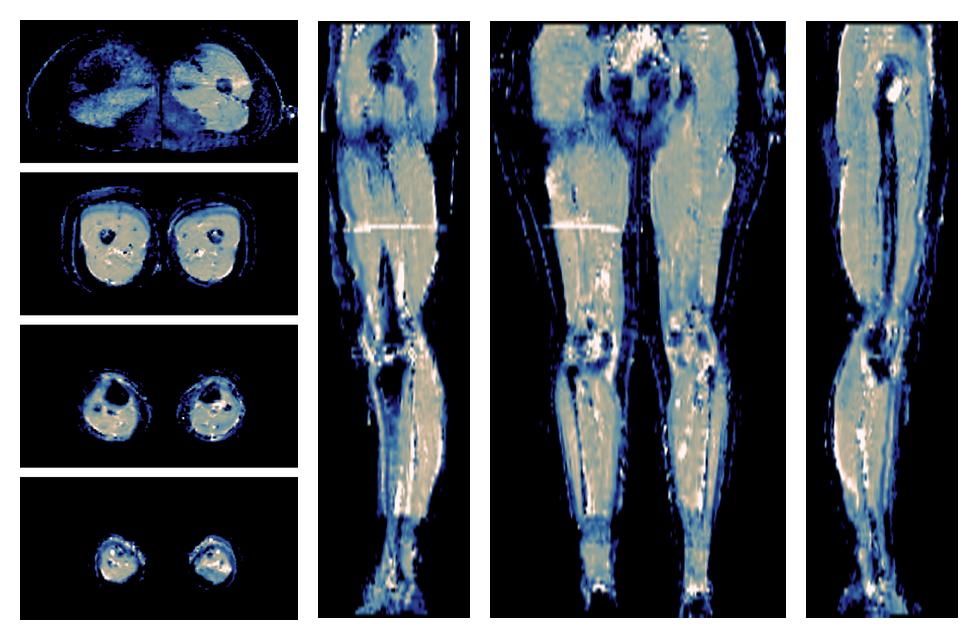 IVIM corrected whole leg muscle mean diffusivity obtained from diffusion tensor imaging.