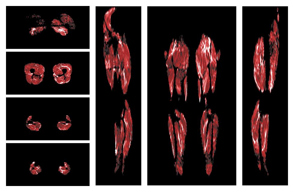 Muscle fiber tract density map based on whole leg DTI based fiber tractography.