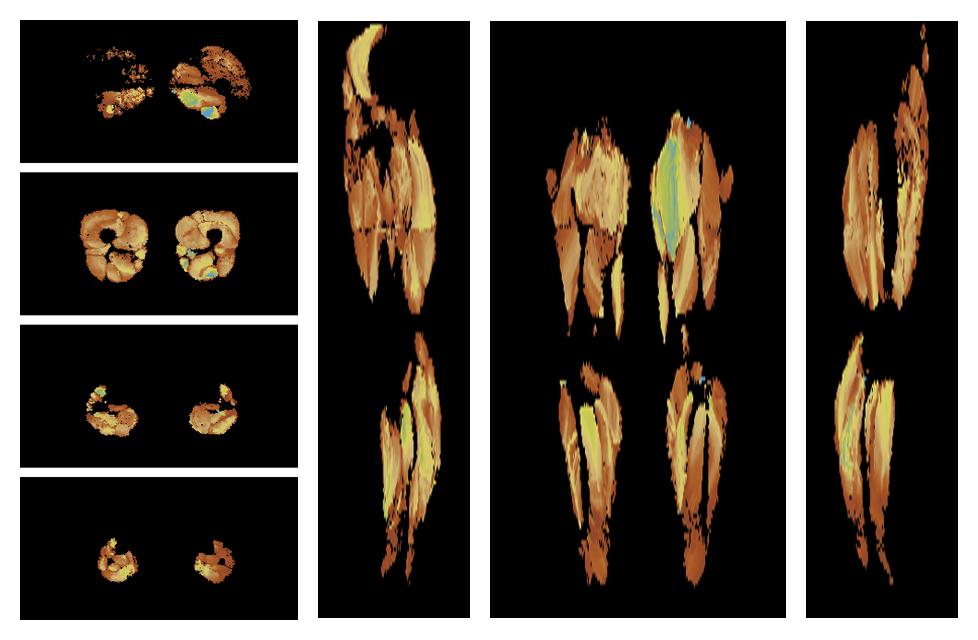 Muscle fiber tract length map based on whole leg DTI based fiber tractography.