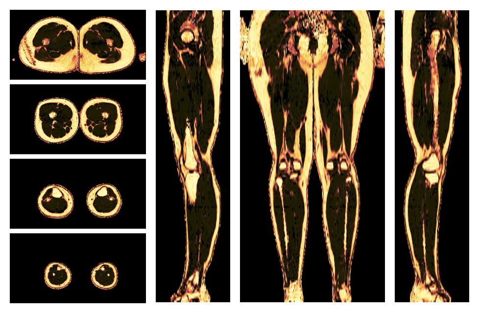 The fat fraction of the lower extremity obtained from the dixon reconstruction for muscle water fat quantification.