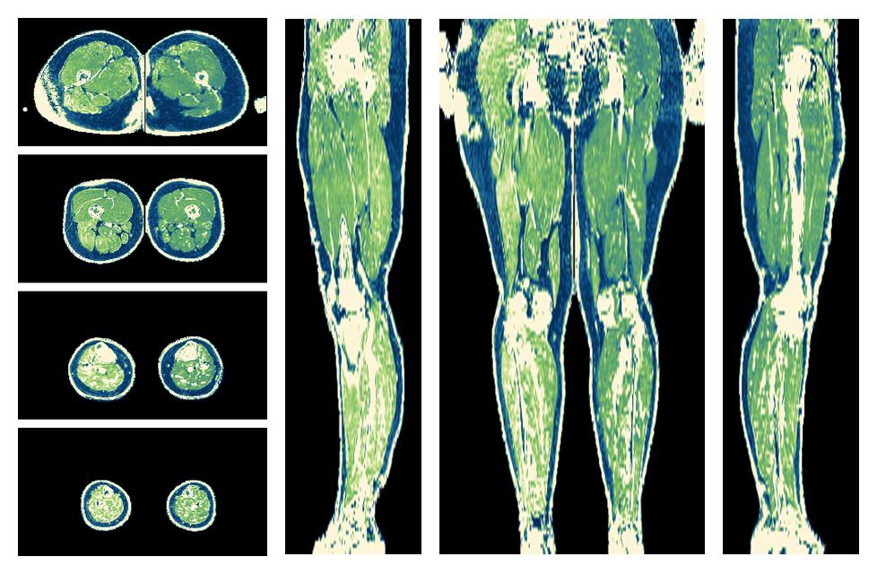 The R2 star relaxation time of the lower extremity obtained from the dixon reconstruction for muscle water fat quantification.