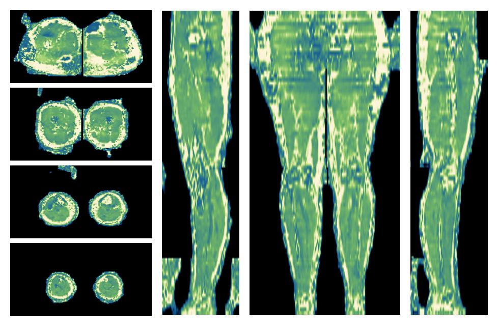 The water only T2 relaxation time of the lower extremity obtained from multi echo spin echo t2 mapping with EPG based reconstruction.