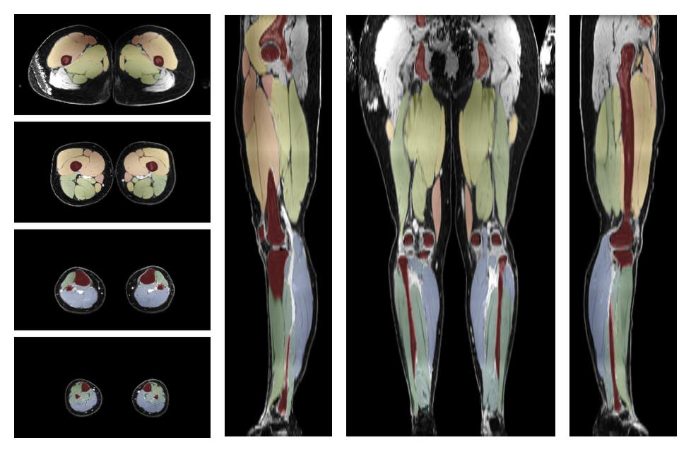 Overlay of automated muscle segmentation labels on dixon water image.