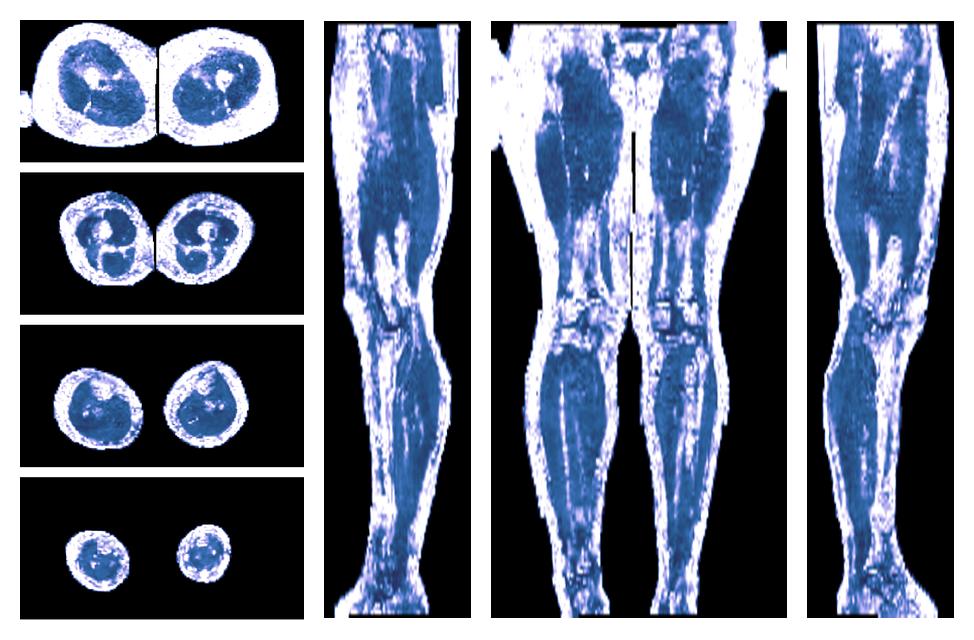 IVIM corrected whole leg muscle fractional anisotropy obtained from diffusion tensor imaging.