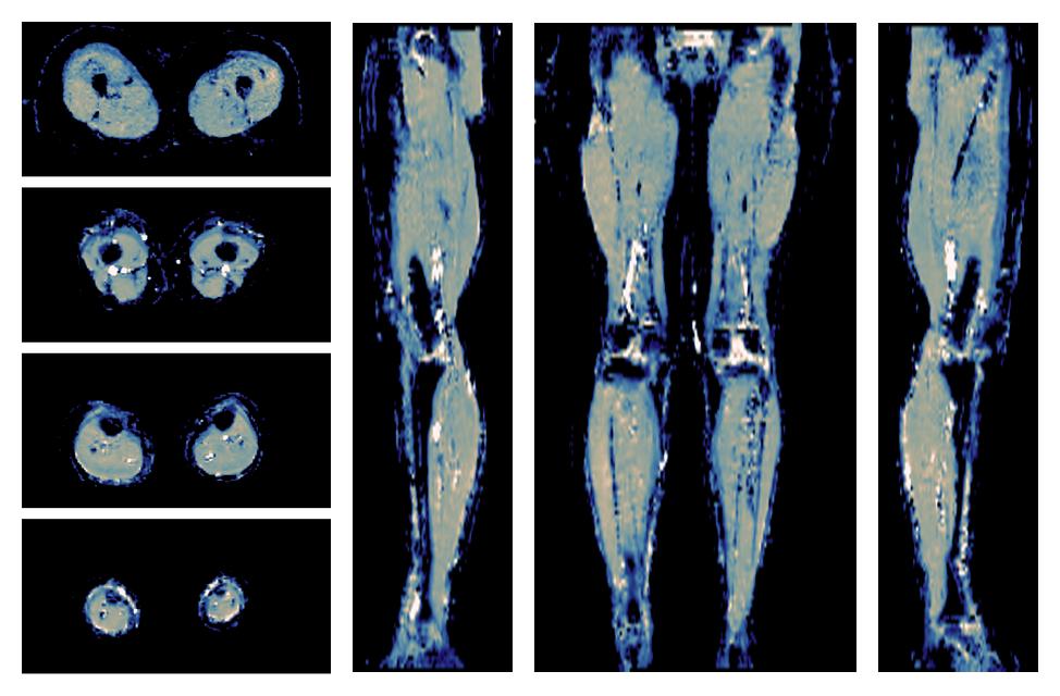 IVIM corrected whole leg muscle mean diffusivity obtained from diffusion tensor imaging.