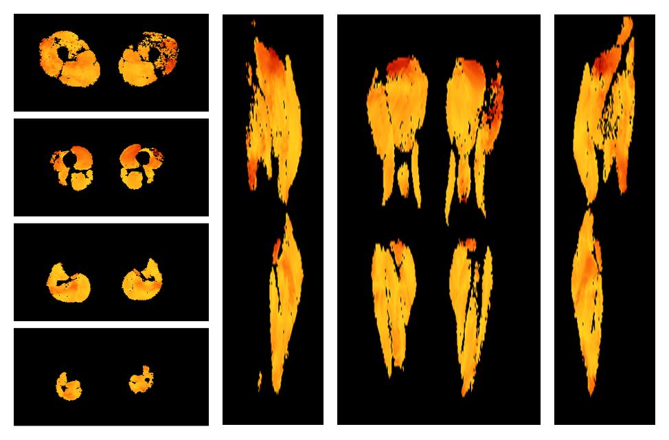 Muscle fiber tract angle map based on whole leg DTI based fiber tractography.