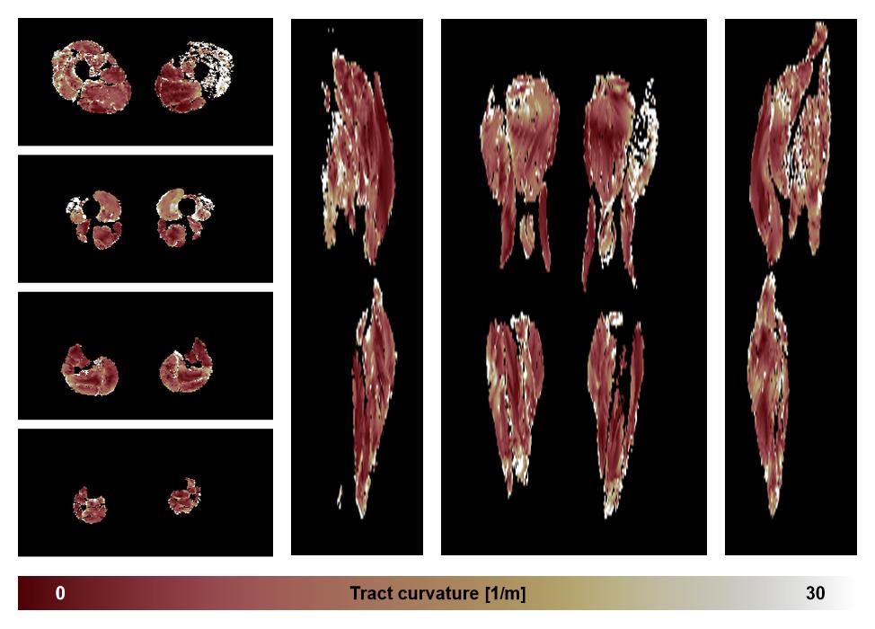 Muscle fiber tract curvature map based on whole leg DTI based fiber tractography.