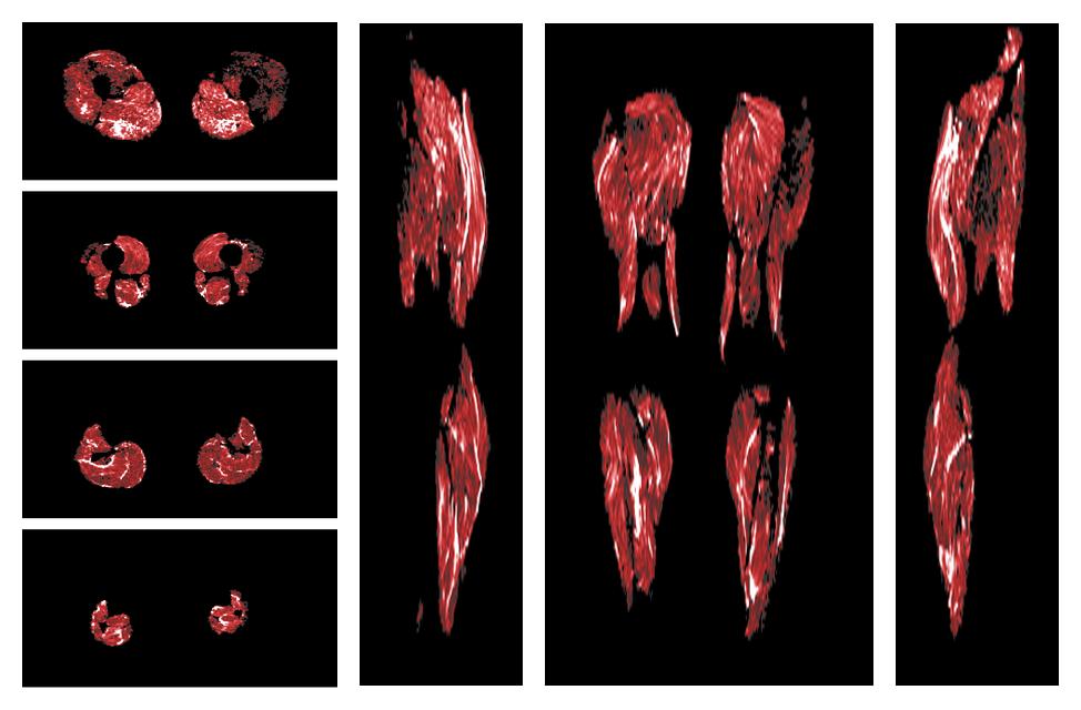 Muscle fiber tract density map based on whole leg DTI based fiber tractography.