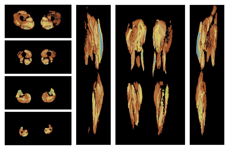 Muscle fiber tract length map based on whole leg DTI based fiber tractography.