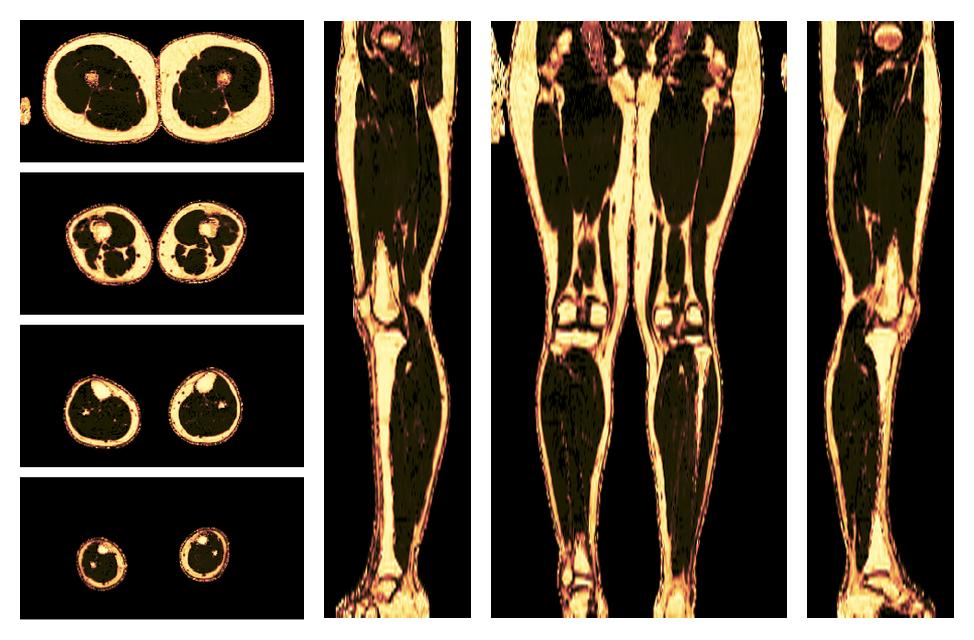 The fat fraction of the lower extremity obtained from the dixon reconstruction for muscle water fat quantification.