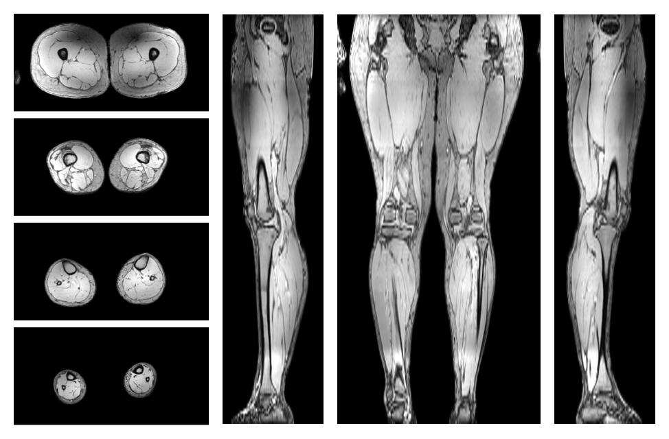 The out-phase image of the dixon reconstruction for water fat quantification.