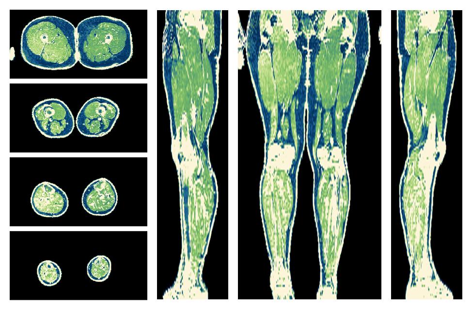 The R2 star relaxation time of the lower extremity obtained from the dixon reconstruction for muscle water fat quantification.