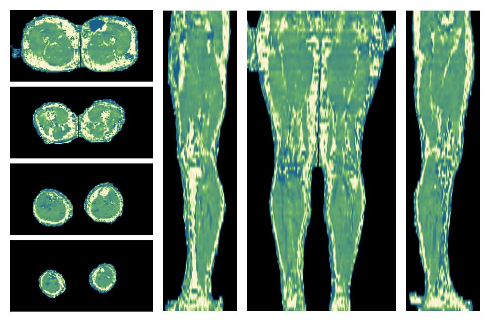 The water only T2 relaxation time of the lower extremity obtained from multi echo spin echo t2 mapping with EPG based reconstruction.