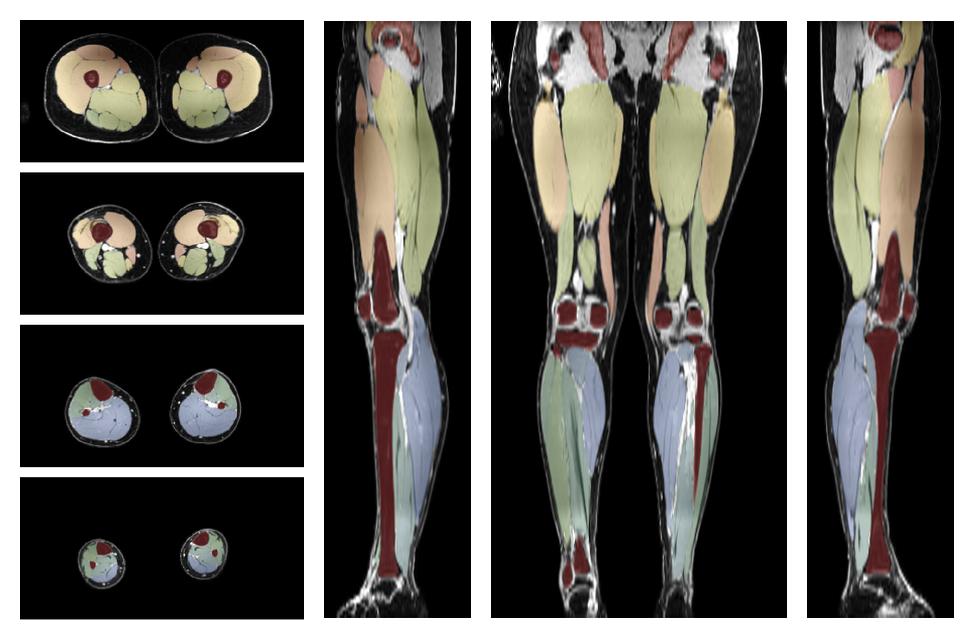 Overlay of automated muscle segmentation labels on dixon water image.