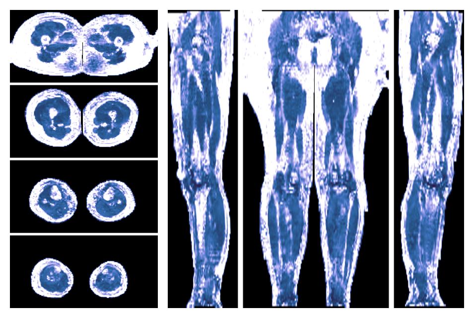 IVIM corrected whole leg muscle fractional anisotropy obtained from diffusion tensor imaging.