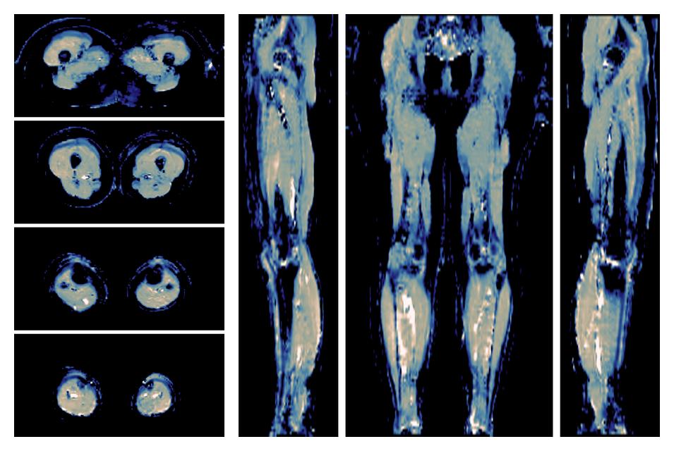 IVIM corrected whole leg muscle mean diffusivity obtained from diffusion tensor imaging.