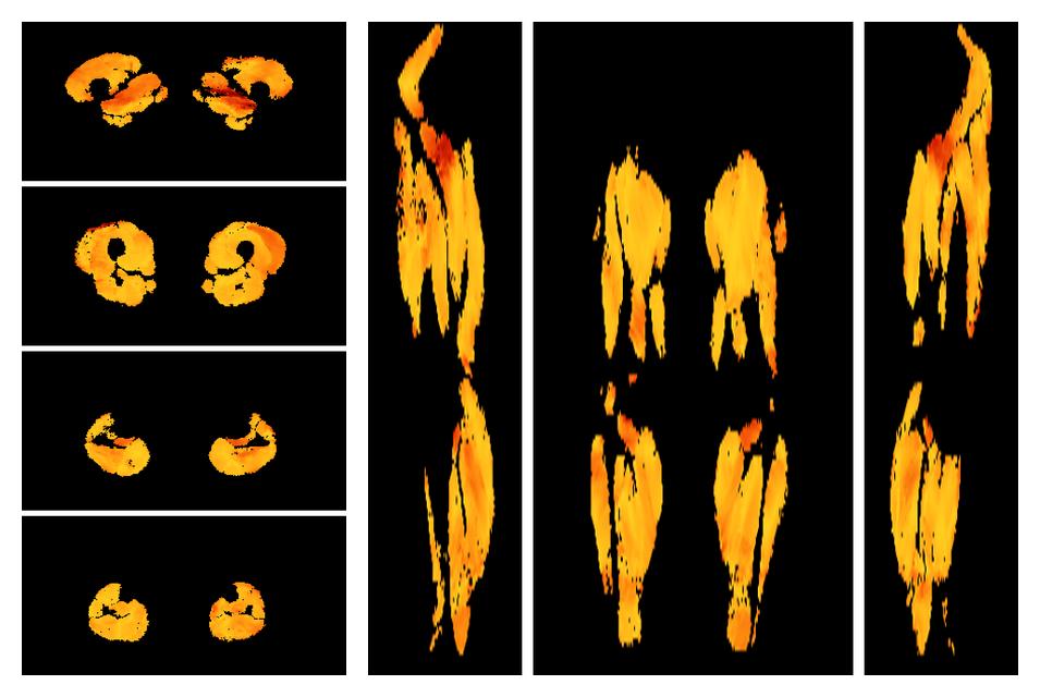 Muscle fiber tract angle map based on whole leg DTI based fiber tractography.