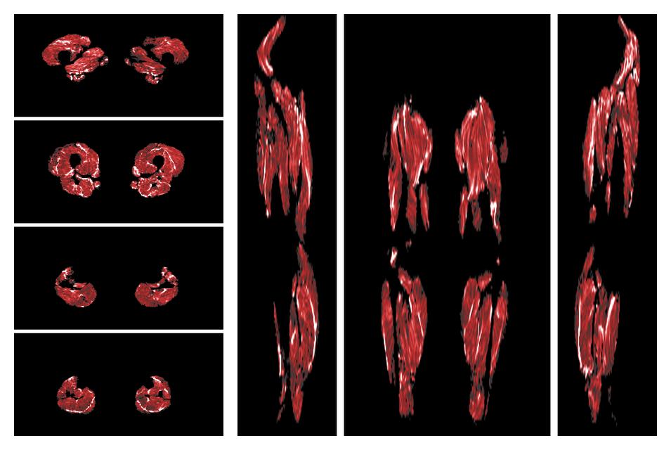 Muscle fiber tract density map based on whole leg DTI based fiber tractography.