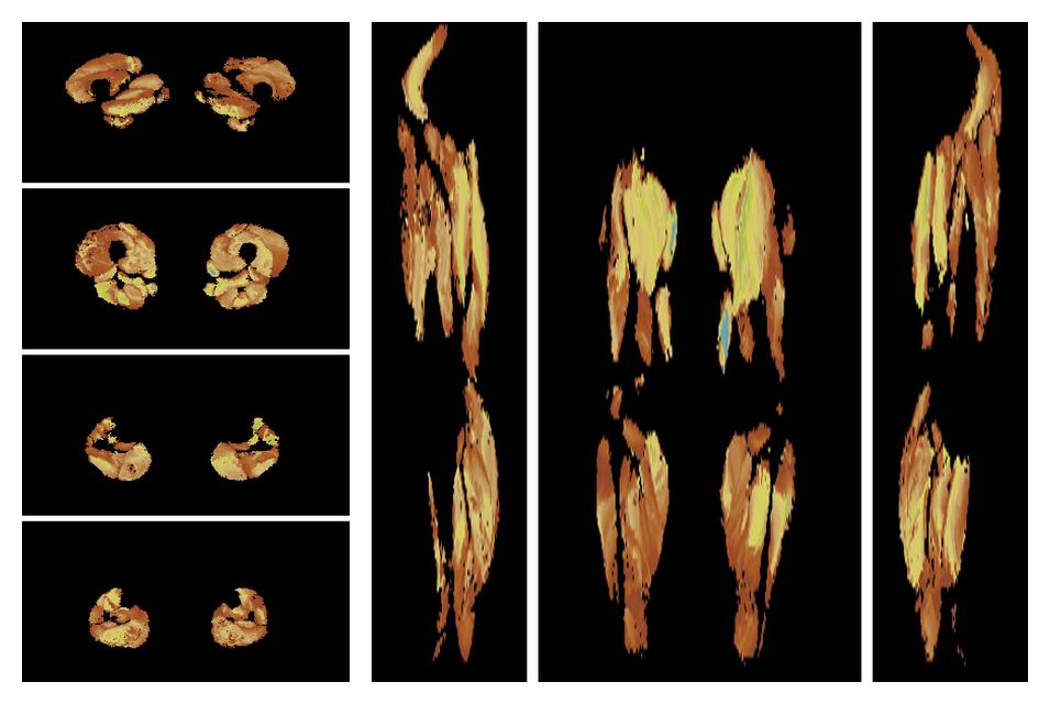 Muscle fiber tract length map based on whole leg DTI based fiber tractography.