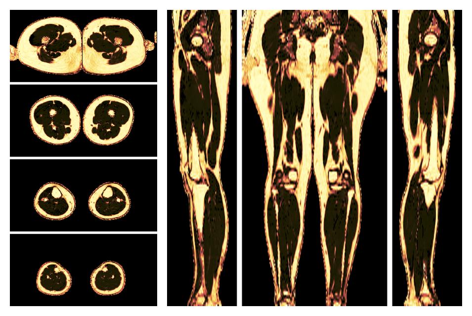 The fat fraction of the lower extremity obtained from the dixon reconstruction for muscle water fat quantification.