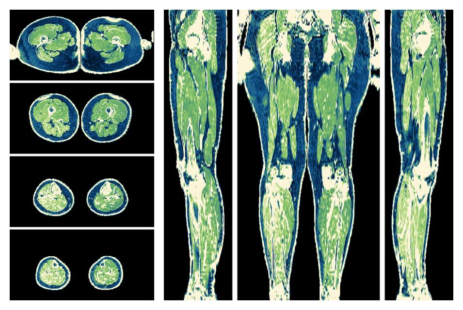 The R2 star relaxation time of the lower extremity obtained from the dixon reconstruction for muscle water fat quantification.