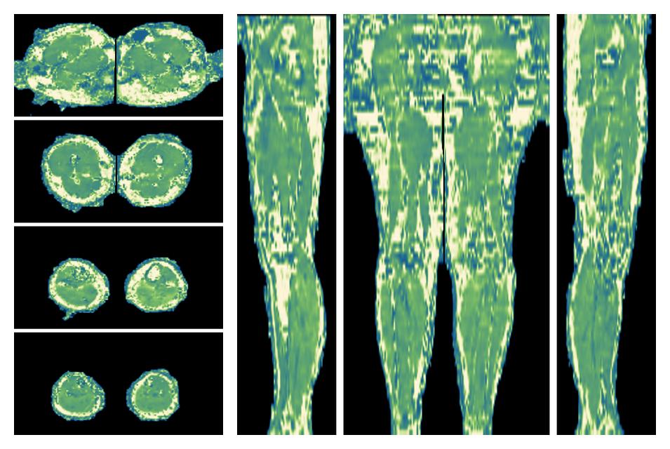 The water only T2 relaxation time of the lower extremity obtained from multi echo spin echo t2 mapping with EPG based reconstruction.