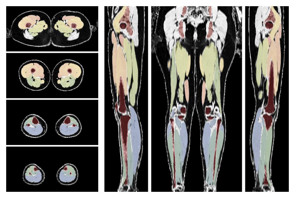 Overlay of automated muscle segmentation labels on dixon water image.