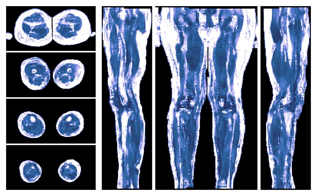 IVIM corrected whole leg muscle fractional anisotropy obtained from diffusion tensor imaging.