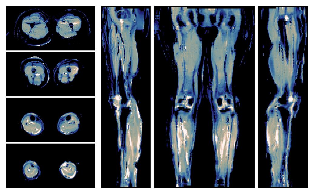 IVIM corrected whole leg muscle mean diffusivity obtained from diffusion tensor imaging.