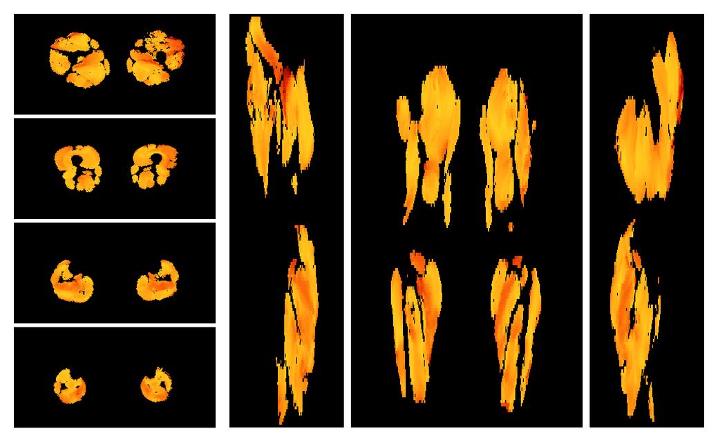 Muscle fiber tract angle map based on whole leg DTI based fiber tractography.